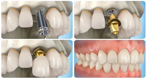 Trồng răng Implant là giải pháp tuyệt vời giúp phục hồi răng mất một cách hiệu quả và lâu dài.