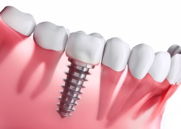 Các phương pháp cấy ghép răng Implant phổ biến tại Nha khoa Flora