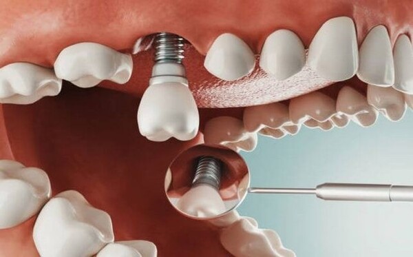 Các bước cấy ghép Implant chuẩn y khoa tại Nha khoa Flora