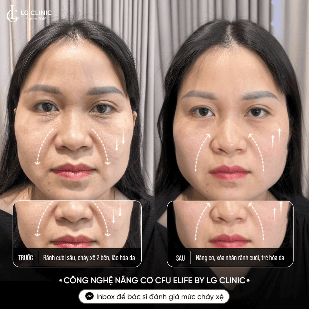 nâng cơ mặt LG Clinic